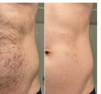 Bauch vorher und nachher