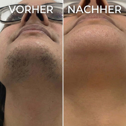 Pflanzlicher Haarwuchsstopp