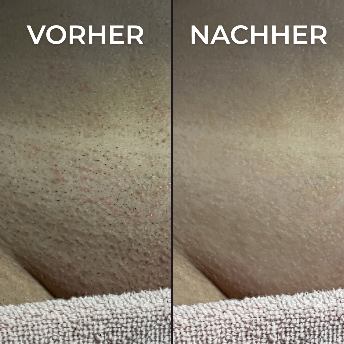 Pflanzlicher Haarwuchsstopp