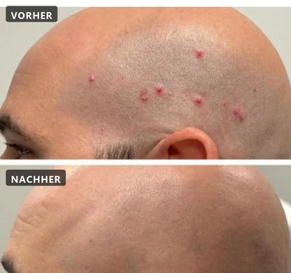 Pflanzlicher Haarwuchsstopp