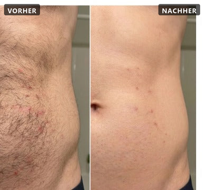 Pflanzlicher Haarwuchsstopp