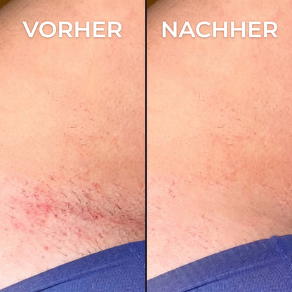 Pflanzlicher Haarwuchsstopp